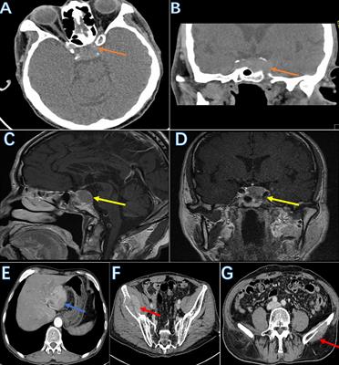 Pituitary metastasis of hepatocellular carcinoma as the initial presentations: a case report and review of the literature